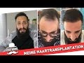 MEINE HAARTRANSPLANTATION in ISTANBUL | BARTMANN