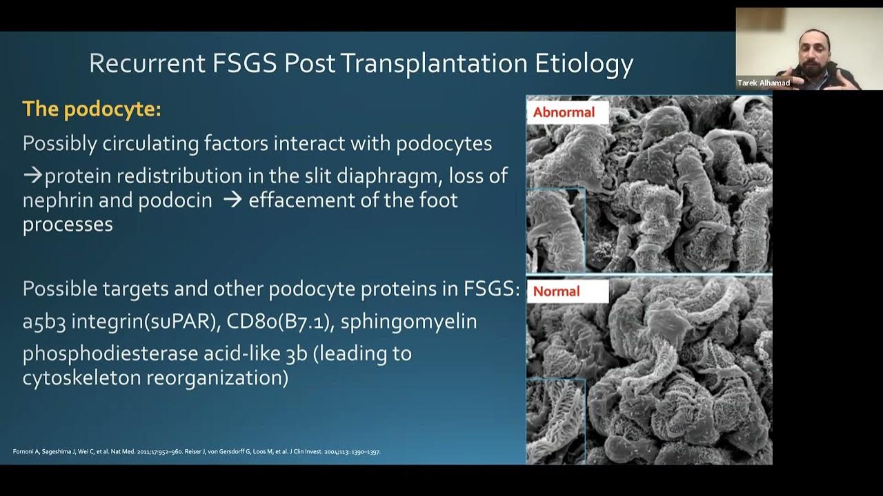 Treating recurrent FSGS in post kidney transplant patients CME