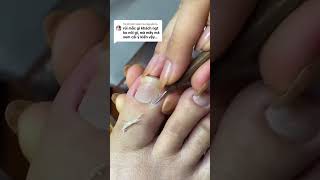 HOW TO CUT THICK TOENAILS nặnmụn nails laykhoe