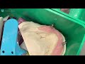 Locator Overdenture