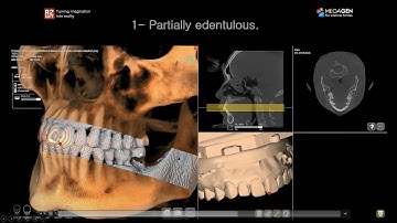 7-  Matching Aligning STL Models with CBCT Scan + Partially edentulous Protocol