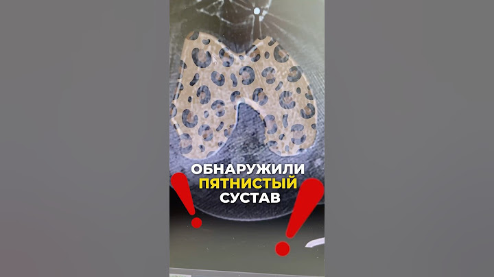 Что будет с костью, если она не работает?