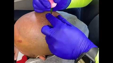 Delaware Scalp Micropigmentation TIME LAPSE SESSION 2