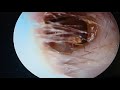 INSECT IN EAR CANAL