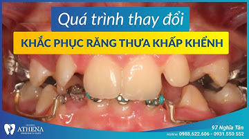 Niềng răng mắc cài kim loại - khắc phục răng thưa khấp khểnh | Nha khoa quốc tế Athena