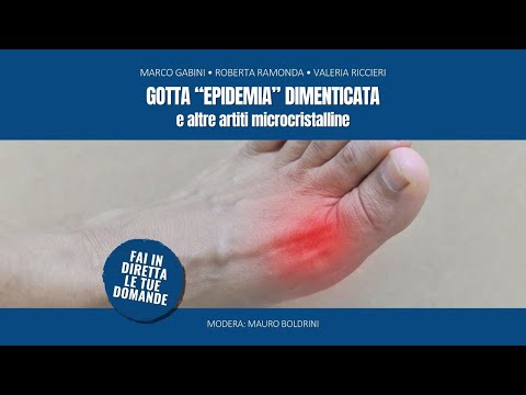 Gotta, “epidemia” dimenticata, e altre artriti microcristalline