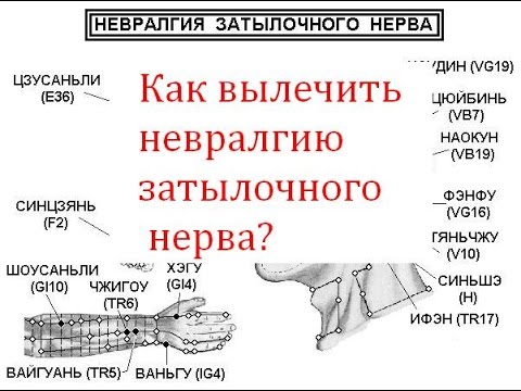 Как вылечить невралгию затылочного нерва?