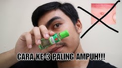 3 CARA CEPAT MENGHILANGKAN JERAWAT | Arief Rahman Hakim AT  - Durasi: 3.51. 