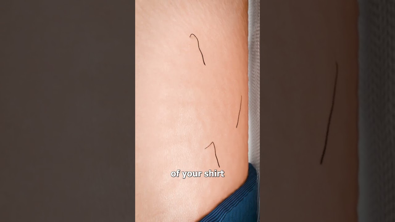 What’s Inside A Pilonidal Cyst? 😨 썸네일