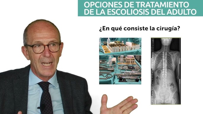 Escoliosis o desviación lateral de columna - Qué es, causas, tipos