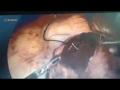 Clinical video 05 thumbnail