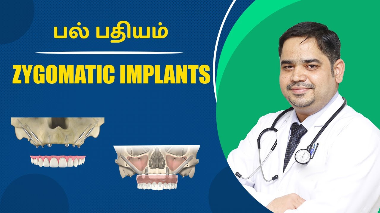 Zygomatic Implant பல் பதியம் Dr Abisheik Johnson Babu Trinity