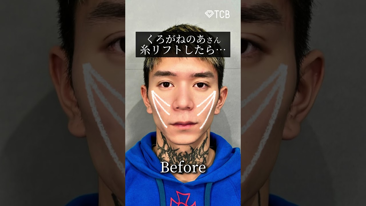 【糸リフト】 くろごねのあさん糸リフトしたら… #shorts