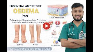 Oedema Explained Part-I | Complete Medical Lecture for OT, Nursing and Medical Students