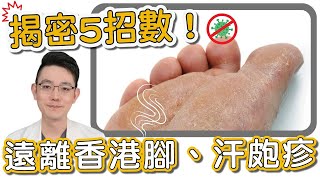 香港腳好不了？治療香港腳不可以三分鐘熱度！香港腳與汗皰疹有何不同？
