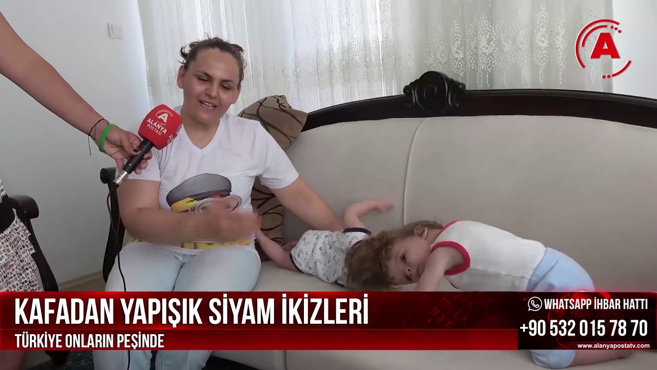 KAFADAN YAPIŞIK SİYAM İKİZLERİ