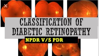 STAGES of DIABETIC RETINOPATHY || mild, moderate, severe NPDR vs PDR