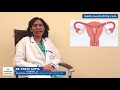 Fallopian Tube Blockage: Symptoms, Causes, Diagnosis and Treatment