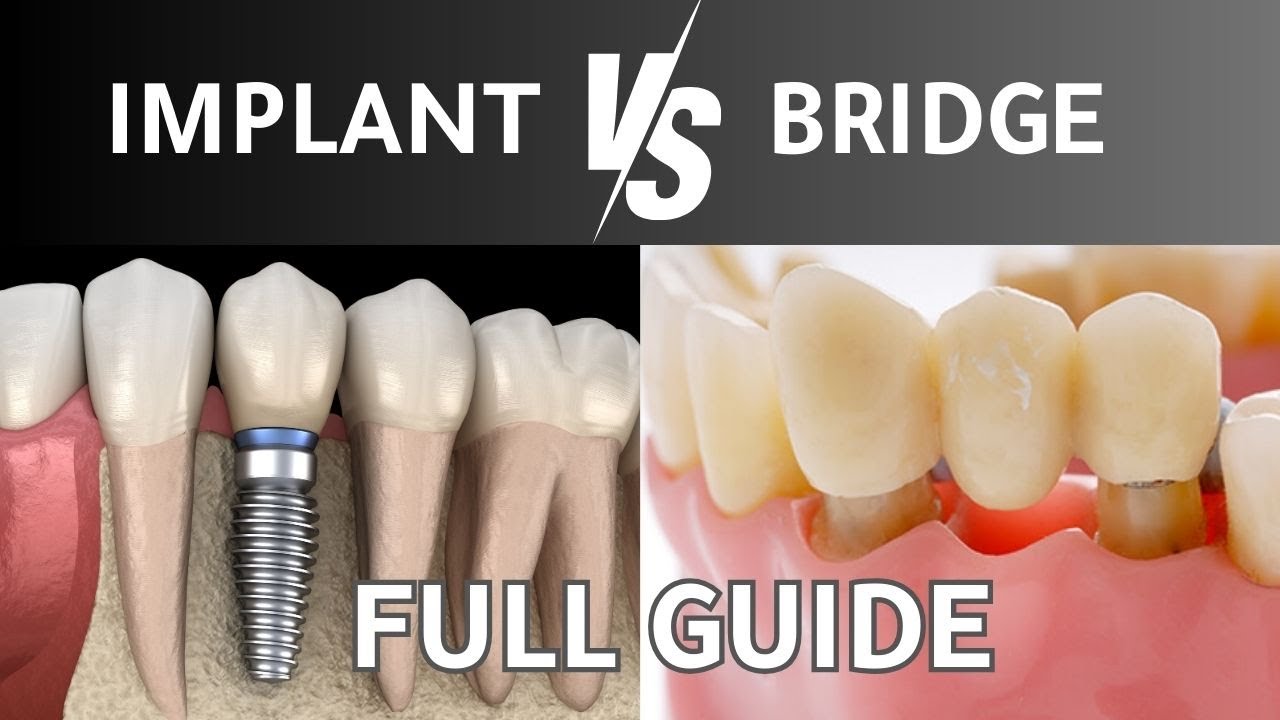 Dental Implants vs. Bridges. FULL GUIDE | What is the BEST option to ...