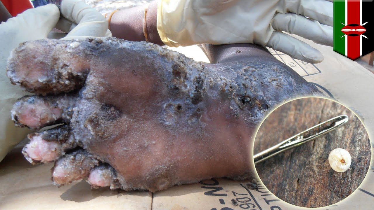 Biskop Ti forbruge Shocking images reveal parasitic 'jigger' fleas burrow into human skin -  YouTube