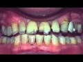 Bruxism - Prevention and Treatment Bruxism - Prevention and Treatment