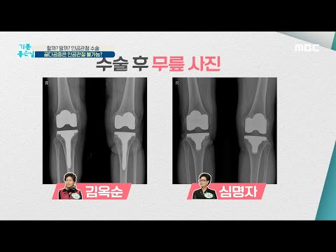 [기분 좋은 날] 골다공증은 인공관절 불가능? 20200512