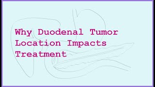Duodenal Neuroendocrine Tumors Why Location Matters For Treatment