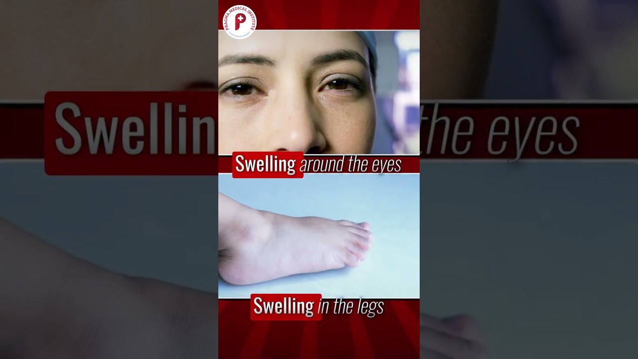 Early Signs of Kidney Damage: Swelling, Protein Leakage & Creatinine | Dr. Preeti Chaudhary