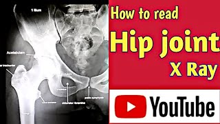 Download Lagu How to read Hip joint X Ray । Hip joint Anatomy । Uday Xray MP3