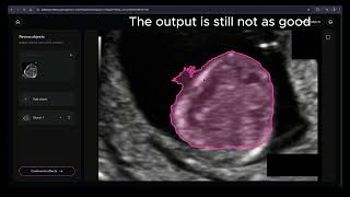 Meta SAM 3 vs. Auta: AI Medical Image Segmentation Showdown