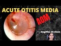 036 ASOM Acute Suppurative Otitis Media 036 ASOM Acute Suppurative Otitis Media