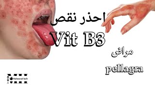 اعرف عن فيتامين ب٣ - الطعام الذي يحتوي على فيتامين B3 -تجنب نقصvitamin B3