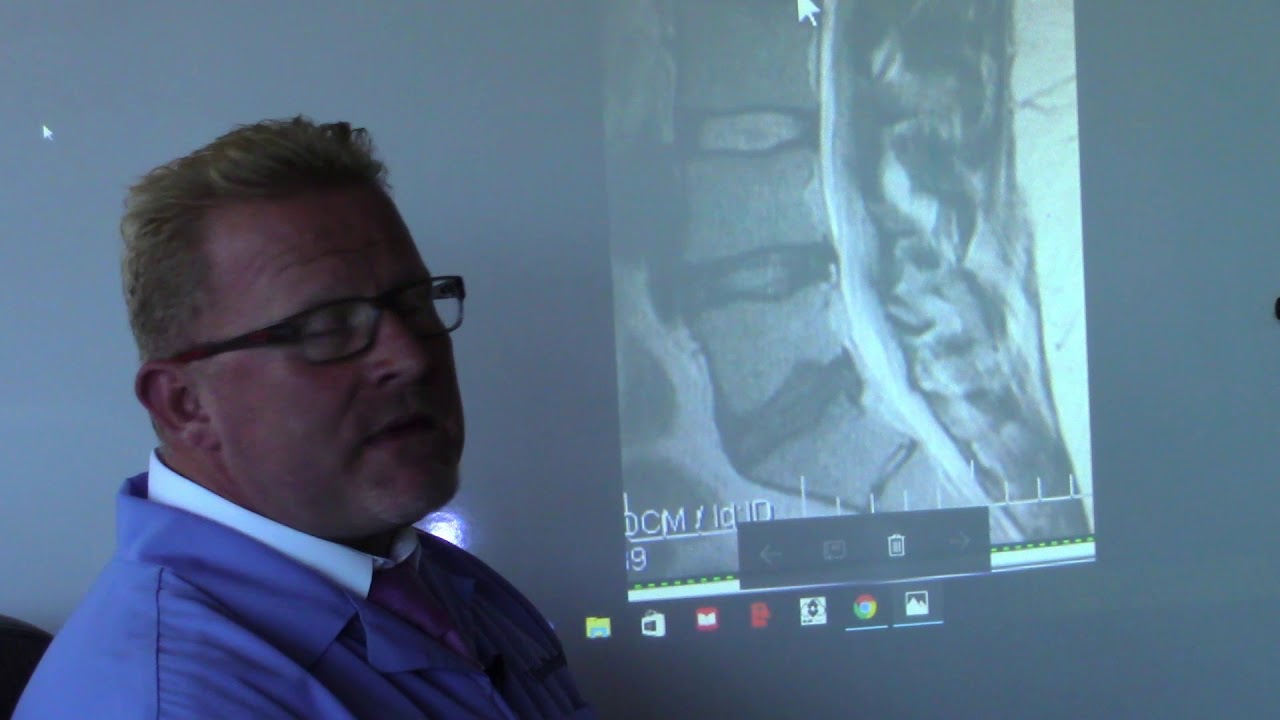 Auto Accident Chiropractor Vancouver Wa - Lumbar MRI Side View of Spine