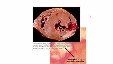 Express Video of the Week: Evolution of Myocardial Infarction