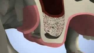 Sinuslift, Greffe Osseuse Sinusienne Pour Pose Dimplant Dentaire
