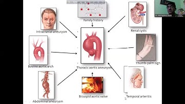 Aortic Aneurysm by Dr. Md. Fakhrul Islam sir