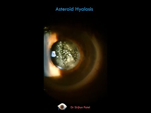 Videó: Asteroid Hyalosis: Tünetek, Okok és Kezelés