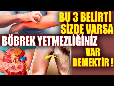 Bu 3 Belirti Sizde Varsa Böbrek Yetmezliğiniz Var Demektir Çaresi 5 Bitkide !