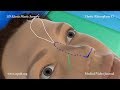 3D Elastic Rhinoplasty