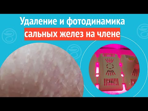 ✅ Удаление и фотодинамика сальных желез на члене. Клинический случай №1131