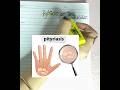 📌 النخالية ( pityriasis )