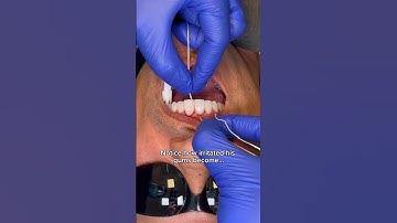 This is how dentist know you haven’t been FLOSSING 🦷🪡 #flosstube #flossing  #satisfying #teeth