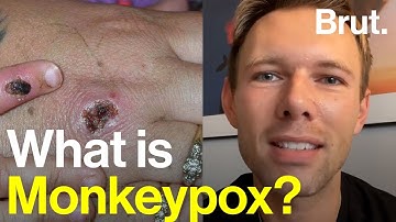 What is it like to have Monkeypox?