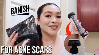 How I use the Banish Starter Kit
