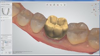 Full anatomical crown on TRIOS® scan