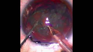 Tilt and Phaco: Effective 44 Seconds for a Soft Cataract   #cataractsurgery #cataractsurgeon screenshot 2