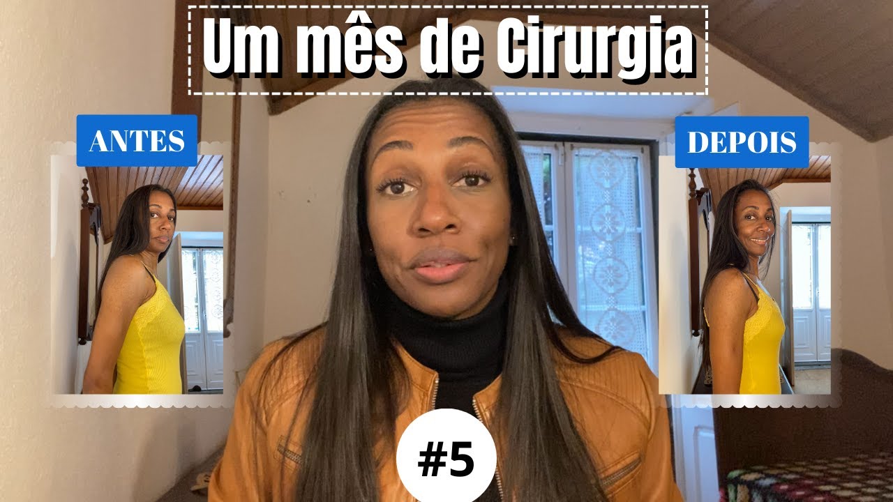 ANTES E DEPOIS Da Minha Mastopexia Sem Pr tese PriFlor YouTube antes-e-depois-da-minha-mastopexia-sem-pr-tese-priflor-youtube