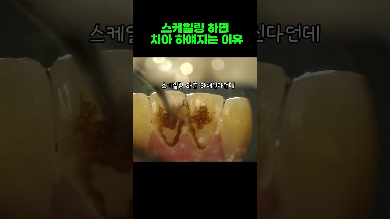 스케일링 하면 치아 하얘지는 이유