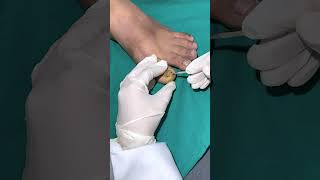 MASSIVE INGROWN TOENAIL REMOVAL |  Toe Nail Surgery | Skinaa Clinic #viral #shorts  #skinaa_clinic