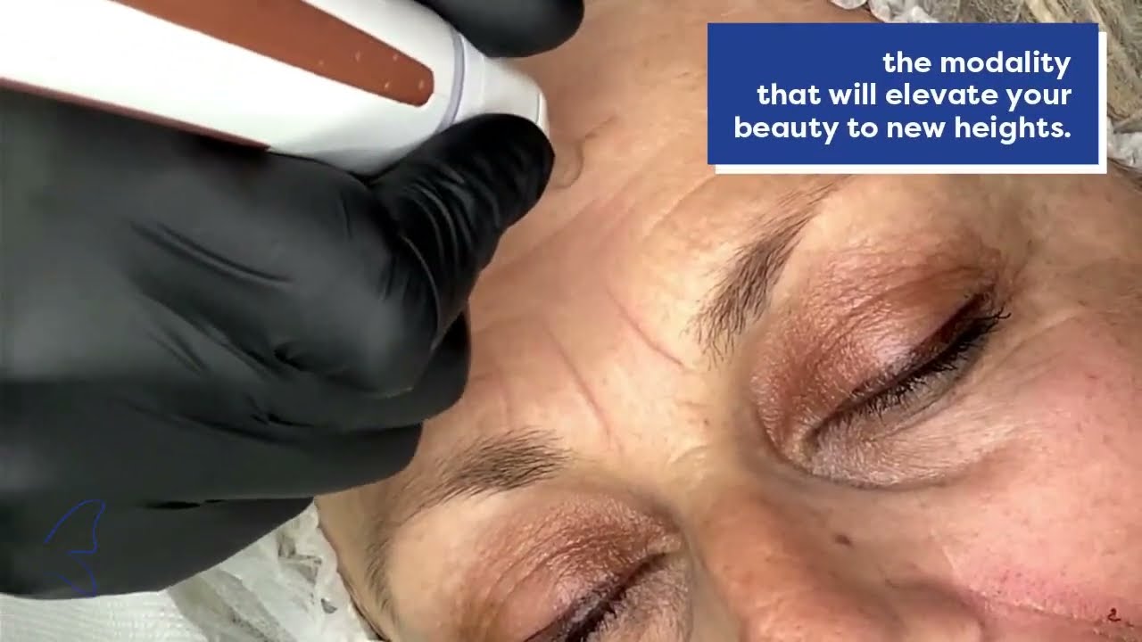 plasmaTIP® for Deep Dermal Rejuvenation